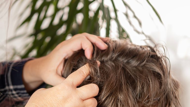Is It Lice or Dandruff on Your Child’s Scalp?