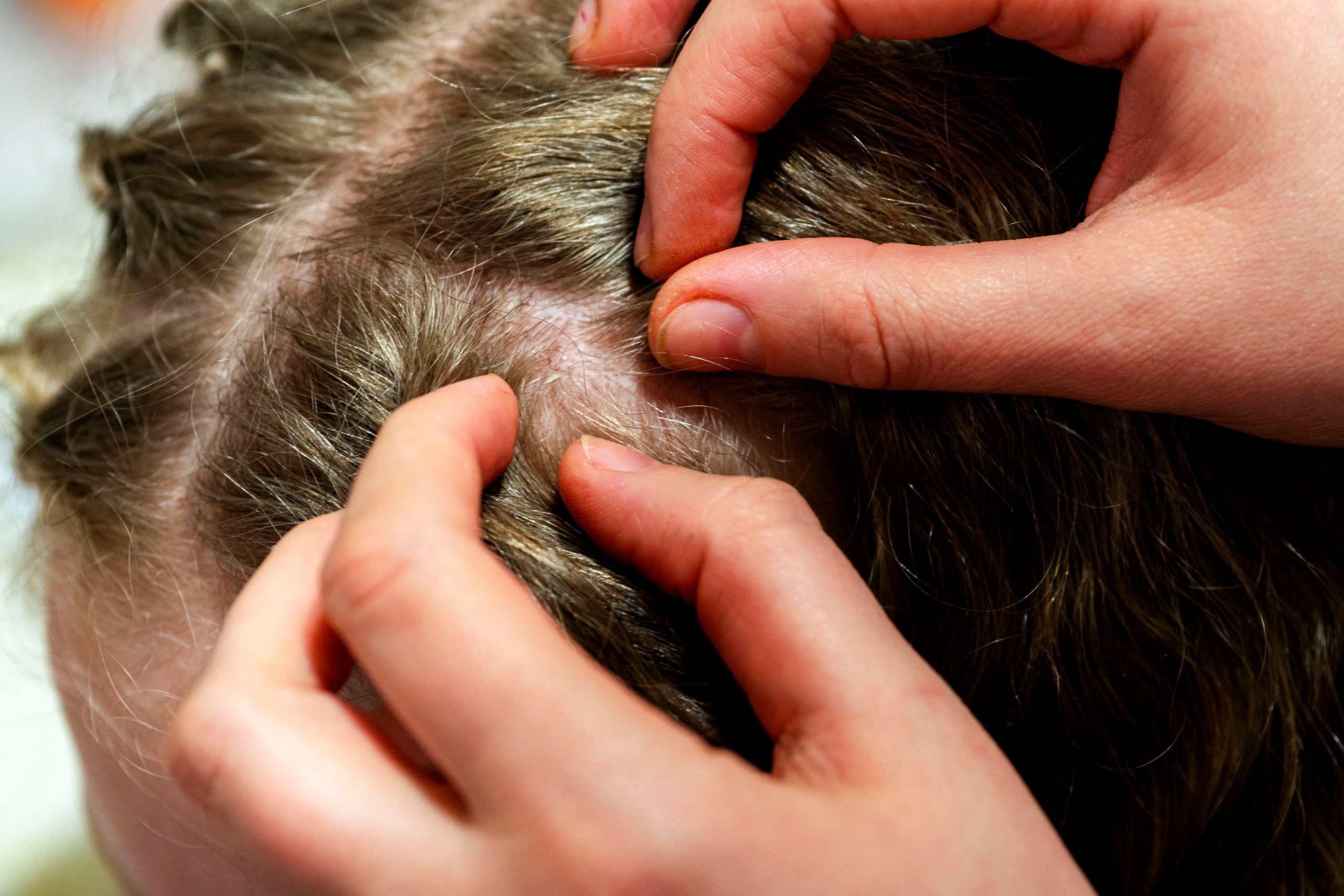 louse on head , girl. Mother checking childs head for lice. hair with lice eggs.