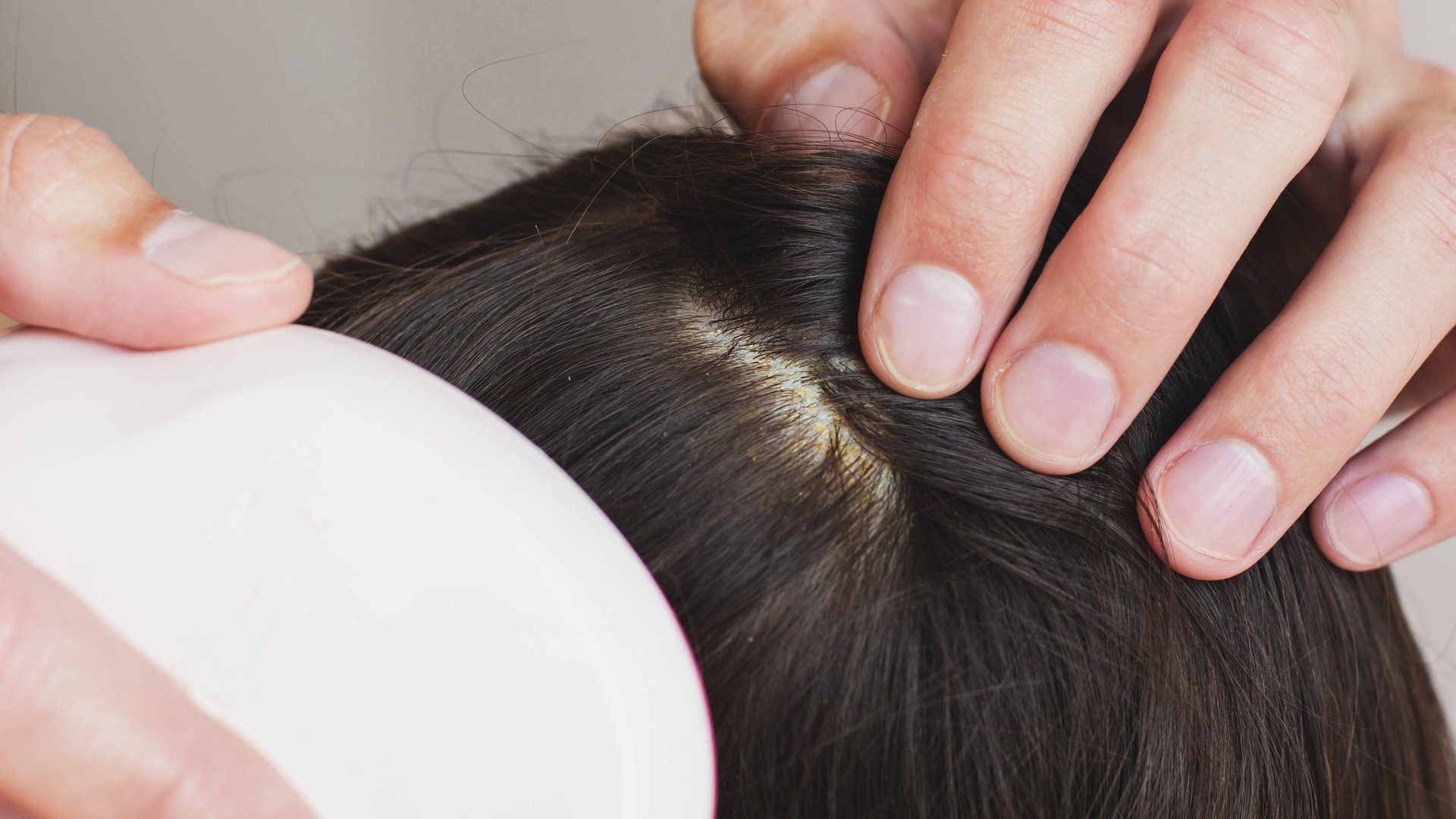 Close-up scalp inspection showing flakes that parents may confuse with head lice nits