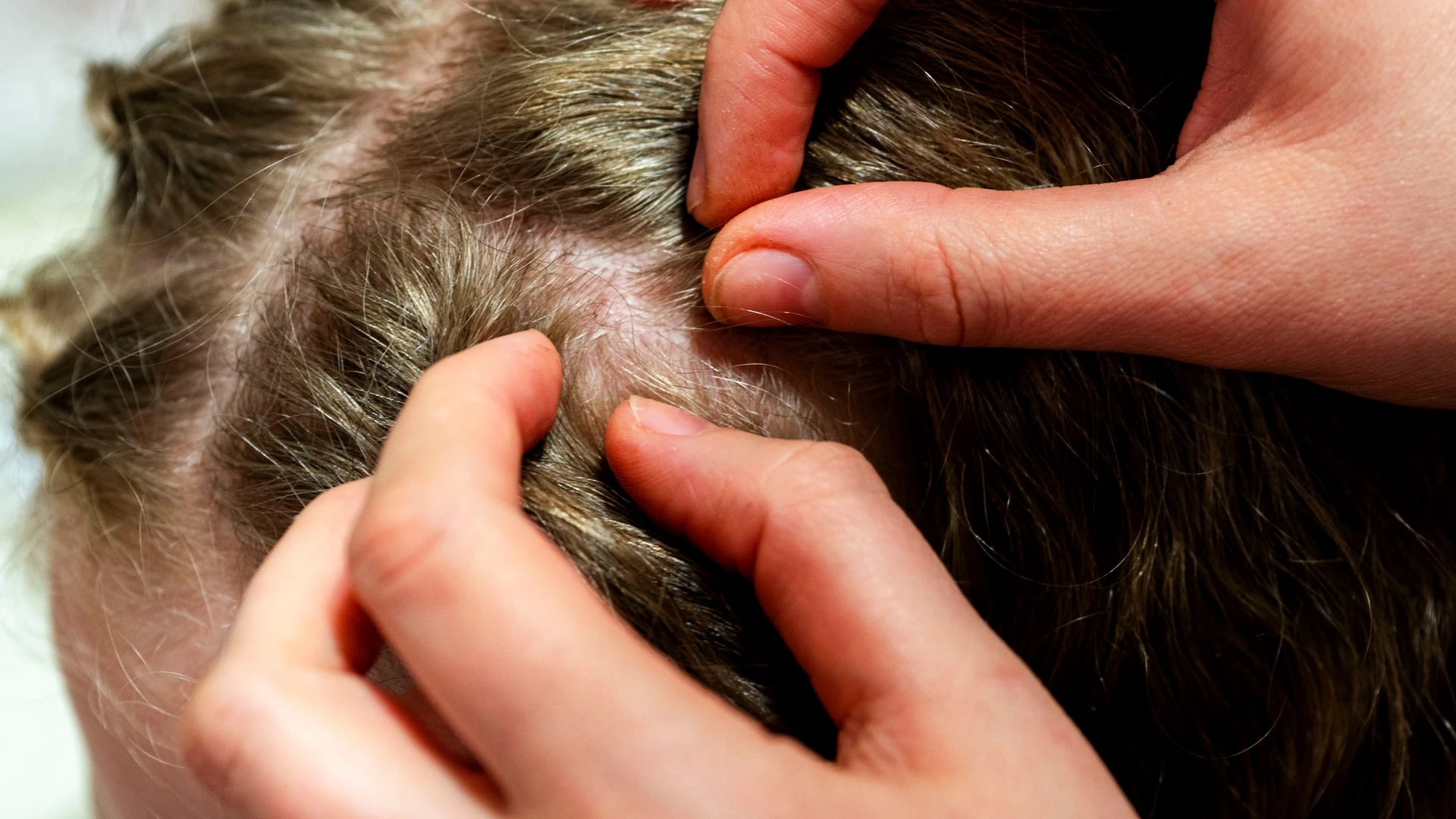 Fingers parting brown hair to expose the scalp.